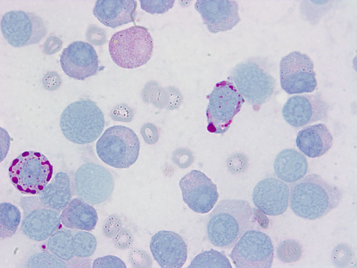 Bone marrow aspirate: PAS+ve cytoplasmic vacules in dyspoietic pronormoblasts